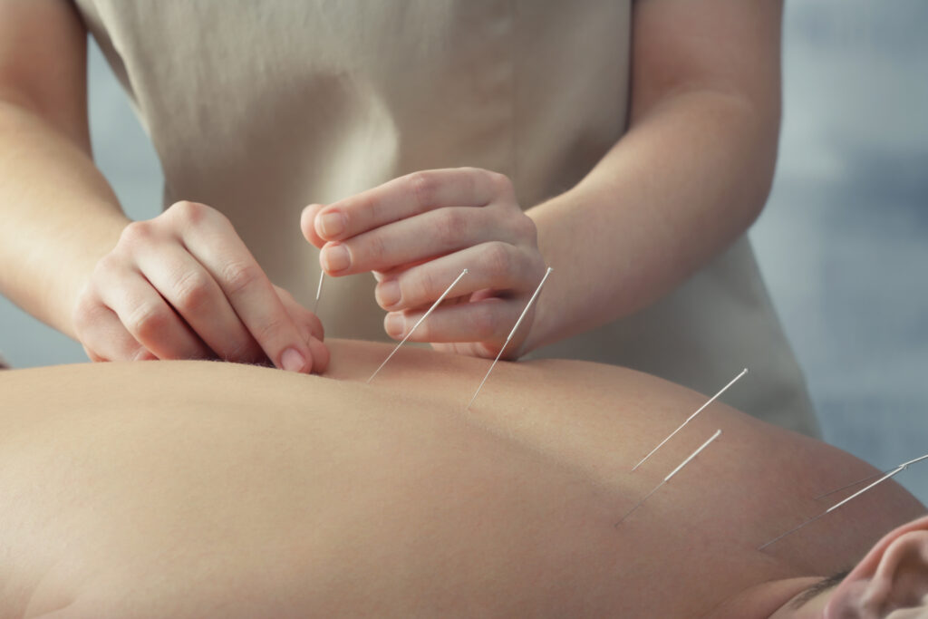 Electroacupuncture at HOROS Yoga Studio Greece Athens